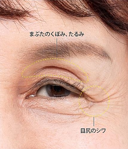 眉上切開および中高年の目元整形の診断のため、瞼のくぼみとたるみ部位、目尻のしわを点線で表示した中高年女性の目のクローズアップ