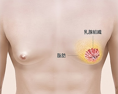 男性の胸の内部にある脂肪と乳腺組織の位置を説明する女性化乳房の構造案内図解
