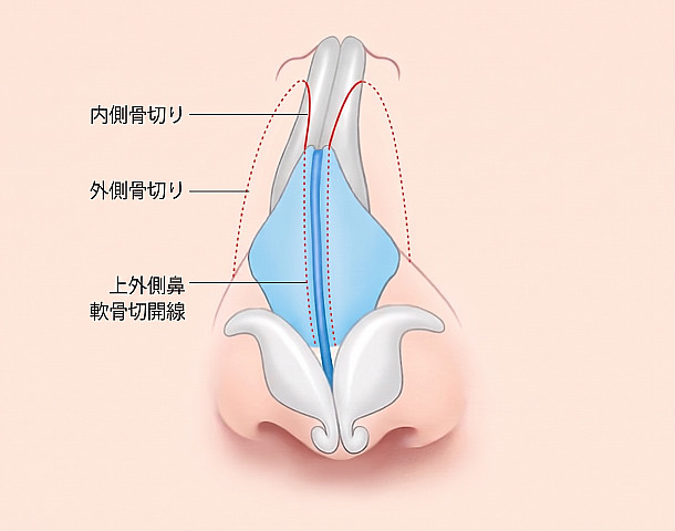 曲がった鼻整形のため、鼻骨と軟骨構造に内側骨切り、外側骨切り、外側鼻軟骨の切開線を表示した手術方法の図解