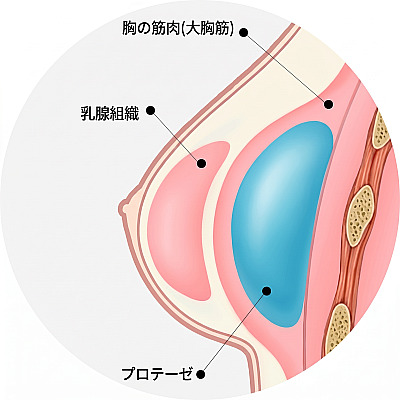 豊胸手術時に大胸筋の下にプロテーゼが位置する構造を示した乳房の解剖学断面図解