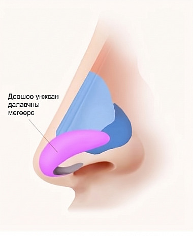 Урт хамар / Шонхор хамар засах мэс заслын үед лавлах доош унжсан далавчит мөгөөрсний байршлыг харуулсан хамрын хажуу талын анатомийн зураг