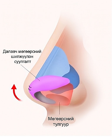 Урт хамар / Шонхор хамар засах үед жигүүрийн мөгөөрсний дахин байршуулалт болон мөгөөрсөн тулгуурын тусламжтайгаар хамрын үзүүрийг өргөх зарчмыг харуулсан хамрын хажуугийн анатомийн зураглал