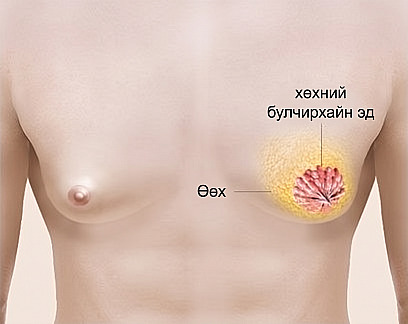 Эрэгтэй хүний цээжин дэх өөх болон хөхний булчирхайлаг эдийн байршлыг тайлбарласан эрэгтэй хүний хөх томролтын бүтцийн зураглал