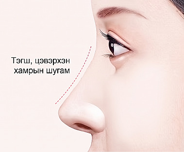 Овгор хамар засах мэс заслын үр дүнд төрсөн эмэгтэйн толигор хамрын шугамын хажуу дүр төрх болон толигор хамрын шугам гэсэн бичиг