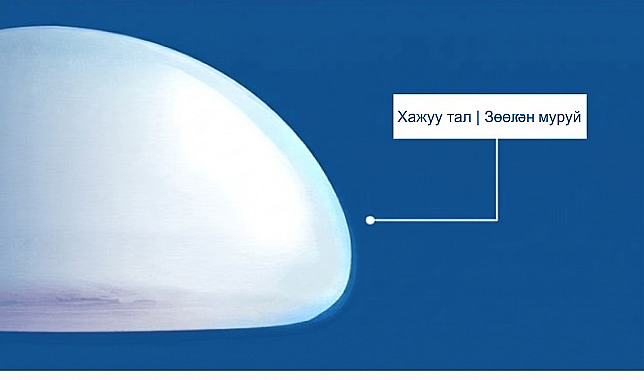 Хөх томруулах мэс засалд ашиглагддаг суулгацын хажуугийн зөөлөн муруй хэлбэрийг томруулсан зураг болон тайлбар бичиг