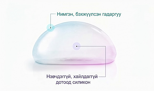 Хөх томруулах мэс засалд ашиглагддаг суулгацын нимгэрүүлж бэхжүүлсэн гадна бүрхүүл болон гоожихгүй, хайлахгүй дотор силикон бүтцийг тайлбарласан зураглал