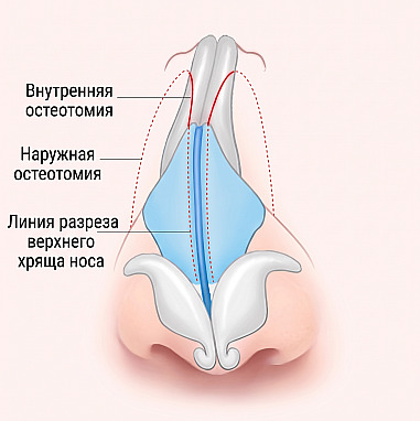 Схема внутреннего строения носа с линиями внутренней и внешней остеотомии, а также разреза верхних латеральных хрящей для мужской ринопластики