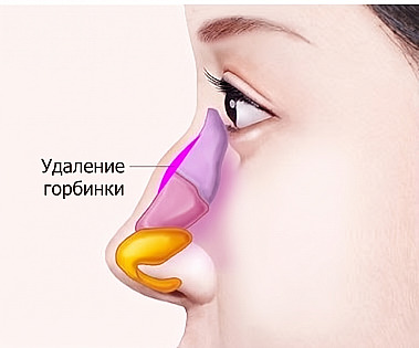 Схема профиля с указанием зоны удаления выступающей костно-хрящевой горбинки при ринопластике