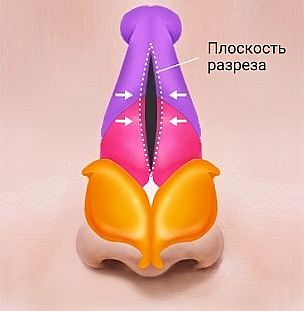 Анатомическая схема носа, показывающая сведение носовых костей после удаления горбинки