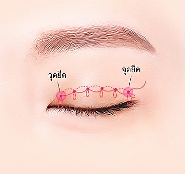 แผนภาพแสดงหลักการทำตาสองชั้นแบบเย็บจุด โดยใช้ไหมร้อยเป็นปมต่อเนื่องตามแนวเปลือกตาที่หลับอยู่และยึดปลายทั้งสองข้าง
