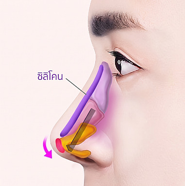 แผนภาพแสดงหลักการเสริมซิลิโคนบริเวณสันจมูกและค้ำยันกระดูกอ่อนปลายจมูกเพื่อเพิ่มความยาวจมูก ในการทำศัลยกรรมจมูกผู้ชาย
