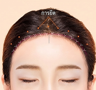 ภาพกราฟิกแนะนำขั้นตอนการดึงหนังศีรษะที่เลาะแล้วตามแนวไรผม ยึดตรึงให้แน่น และเย็บแผลอย่างประณีตในการผ่าตัดลดขนาดหน้าผาก