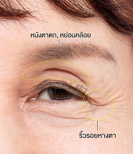 ภาพโคลสอัพดวงตาของหญิงวัยกลางคนที่มีการทำเครื่องหมายเส้นประบริเวณเปลือกตาที่ลึกและหย่อนคล้อย รวมถึงริ้วรอยหางตา เพื่อการวินิจฉัยผ่าตัดยกคิ้วเหนือคิ้วและศัลยกรรมตาวัยกลางคน