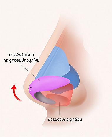 ภาพแผนผังกายวิภาคด้านข้างของจมูกแสดงหลักการยกปลายจมูกด้วยการจัดตำแหน่งกระดูกอ่อนปีกจมูกใหม่และใช้กระดูกอ่อนค้ำยันในการผ่าตัดศัลยกรรมจมูกยาว / จมูกงุ้ม
