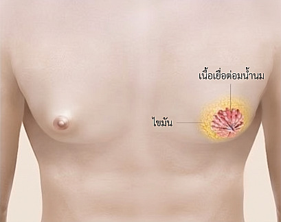ภาพประกอบทางการแพทย์แสดงตำแหน่งของเนื้อเยื่อต่อมน้ำนมและไขมัน เพื่ออธิบายสาเหตุของภาวะเต้านมโตในเพศชาย