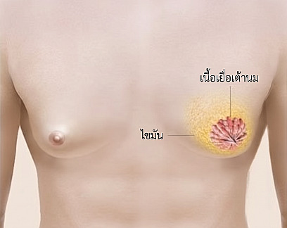 ภาพแผนผังโครงสร้างภาวะเต้านมโตในเพศชาย อธิบายตำแหน่งของไขมันและต่อมน้ำนมภายในหน้าอกของผู้ชาย