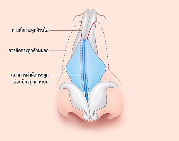 ภาพแผนภาพแสดงวิธีการผ่าตัดแก้ไขจมูกคด โดยระบุแนวกระดูกตัดด้านใน กระดูกตัดด้านนอก และรอยกรีดกระดูกอ่อนส่วนบนของจมูก