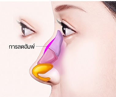 ภาพแผนภาพด้านข้างแสดงตำแหน่งการตัดฮัมพ์ โดยเหลากระดูกและกระดูกอ่อนที่นูนบริเวณสันจมูกออกในการทำศัลยกรรมจมูกฮัมพ์