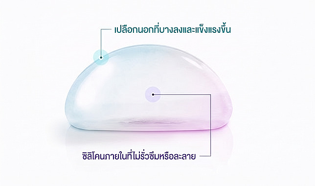 แผนภาพอธิบายโครงสร้างซิลิโคนภายในที่ไม่รั่วซึมหรือละลาย และเปลือกหุ้มที่บางลงแต่แข็งแรงขึ้นสำหรับซิลิโคนที่ใช้ในการผ่าตัดเสริมหน้าอก