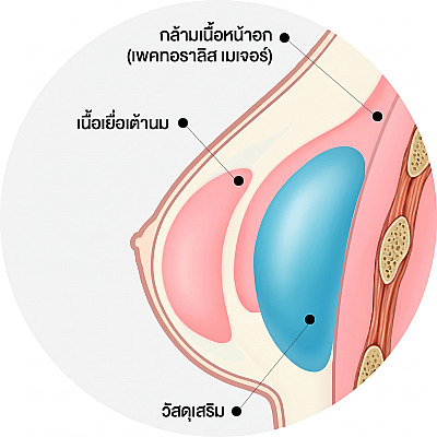 ภาพตัดขวางทางกายวิภาคแสดงโครงสร้างซิลิโคนที่อยู่ใต้กล้ามเนื้อหน้าอกใหญ่และเนื้อเยื่อเต้านมในการผ่าตัดเสริมหน้าอก
