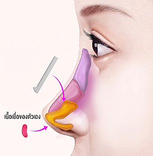 ภาพกายวิภาคด้านข้างแสดงขั้นตอนการใส่ซิลิโคนที่สันจมูกและเนื้อเยื่อตัวเองที่บริเวณปลายจมูก ในการศัลยกรรมจมูกสั้น