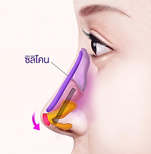 ภาพแผนภาพหลักการผ่าตัดจมูกสั้น/จมูกเหิน โดยการใส่ซิลิโคนบริเวณสันจมูกและจัดเรียงกระดูกอ่อนปลายจมูกใหม่เพื่อเพิ่มความยาว