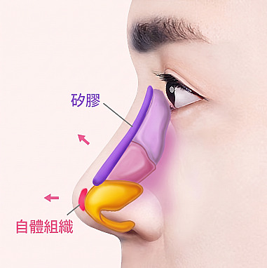 男性隆鼻側面圖解，展示鼻樑植入矽膠假體及鼻尖使用自體組織的位置