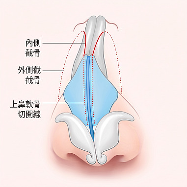 男性隆鼻中內側截骨、外側截骨、上外側軟骨切口線部位的鼻部內部構造圖解