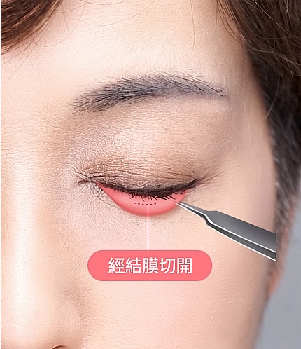 經結膜眼下脂肪移位手術方法圖解，以紅色虛線標示閉眼時眼瞼內側結膜切口部位並標有經結膜切開字樣