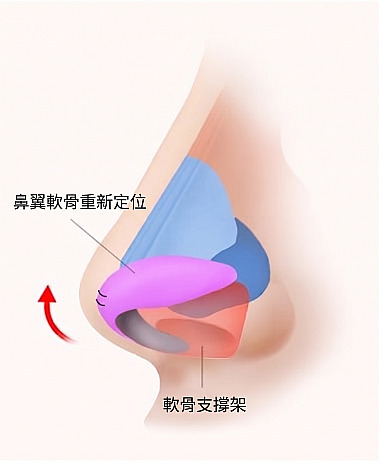 長鼻／箭頭鼻整形鼻側面解剖圖解，展示透過鼻翼軟骨移位與軟骨支撐架達成鼻尖拉提的原理解說