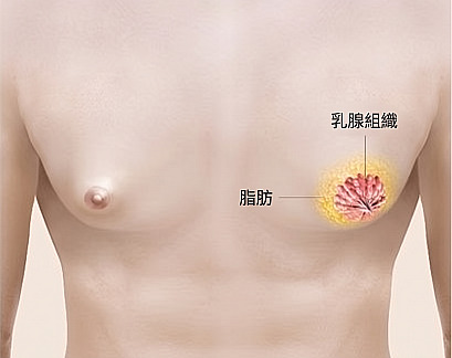 說明男性女乳症成因的醫學插圖，標示乳腺組織與脂肪的位置