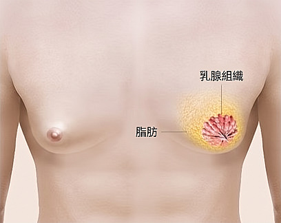 說明男性胸部內部脂肪與乳腺組織位置的男性女乳症構造說明圖解