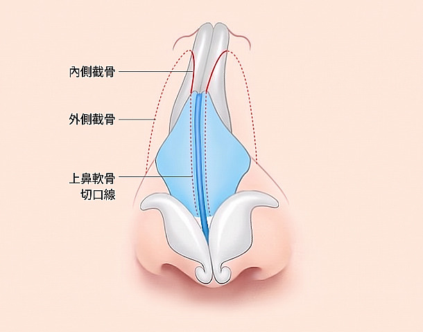 歪鼻矯正手術方法圖解，在鼻骨與軟骨結構上標示內側截骨、外側截骨及上側鼻軟骨切口線