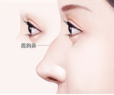 APEX 整形外科鼻整形說明圖解，展示鼻樑中段凸出的駝峰鼻女性側面，並以線條標示駝峰部位