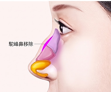 駝峰鼻整形時標示出切除鼻樑凸出骨骼與軟骨部位的側臉圖解