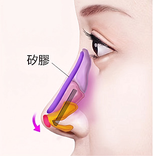 短鼻/朝天鼻手術原理圖解，展示在鼻樑植入矽膠假體並重新排列鼻尖軟骨以延長長度