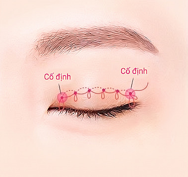 Sơ đồ thể hiện nguyên lý nối chỉ thắt nút liên tục dọc theo nếp mí nhắm và cố định hai đầu trong phẫu thuật mắt hai mí không phẫu thuật (không rạch da)