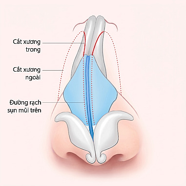 Sơ đồ cấu trúc bên trong mũi thể hiện vị trí đường rạch sụn mũi trên cùng kỹ thuật gọt xương bên trong và bên ngoài trong phẫu thuật mũi nam giới