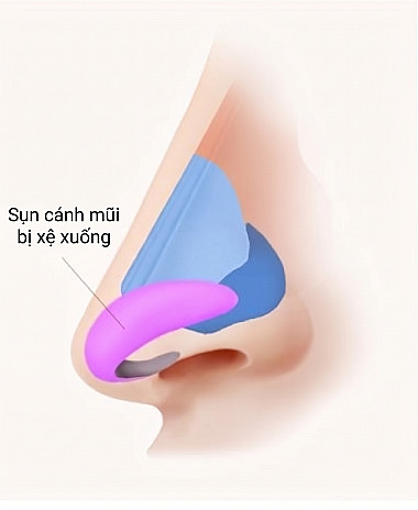 Sơ đồ giải phẫu mặt bên của mũi thể hiện sụn cánh mũi xệ xuống dưới dùng tham khảo khi phẫu thuật mũi dài và mũi khoằm