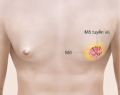 Minh họa y khoa chỉ rõ vị trí của mô tuyến vú và mỡ nhằm giải thích nguyên nhân gây nữ hóa tuyến vú ở nam giới
