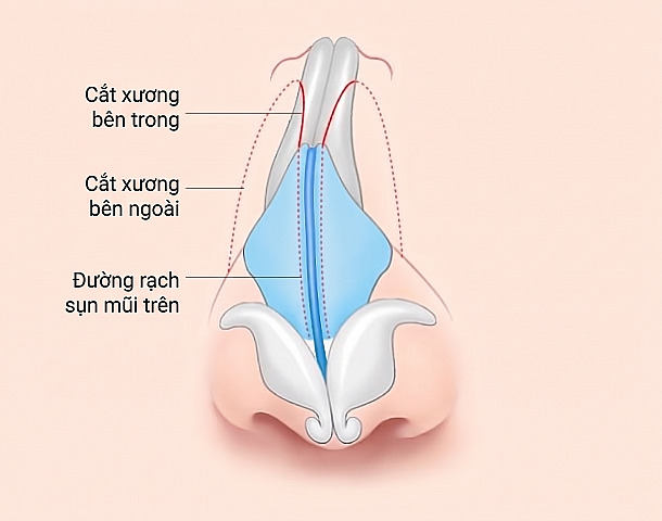 Sơ đồ phương pháp phẫu thuật chỉ rõ đường cắt xương trong, cắt xương ngoài và đường rạch sụn mũi trên trên cấu trúc xương và sụn để phẫu thuật mũi vẹo