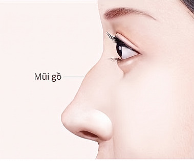 Sơ đồ hướng dẫn phẫu thuật mũi của Thẩm mỹ viện APEX thể hiện góc nghiêng của phụ nữ có mũi gồ với phần giữa sống mũi nhô lên và đường chỉ rõ phần gồ
