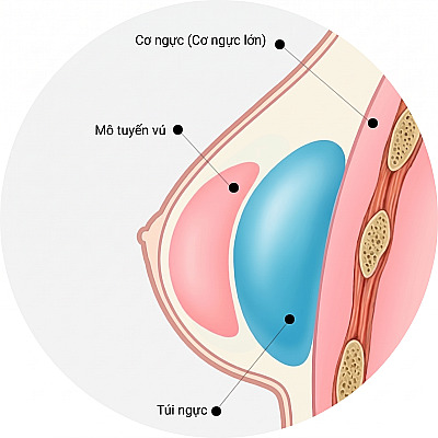 Sơ đồ cấu trúc mặt cắt thể hiện vị trí đặt túi độn dưới màng cơ hoặc dưới tuyến sữa (dưới mô tuyến vú và trên cơ ngực lớn) khi nâng ngực