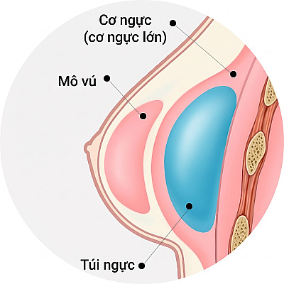 Hình minh họa mặt cắt giải phẫu ngực thể hiện cấu trúc túi độn được đặt dưới cơ ngực lớn khi phẫu thuật nâng ngực