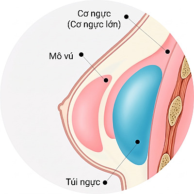 Sơ đồ mặt cắt giải phẫu thể hiện cấu trúc túi độn đặt dưới cơ ngực lớn và mô tuyến vú khi phẫu thuật nâng ngực