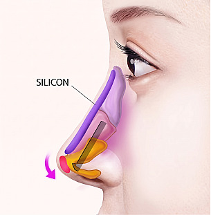 Sơ đồ nguyên lý phẫu thuật đặt sụn nhân tạo silicone vào sống mũi và tái sắp xếp sụn đầu mũi để kéo dài mũi khi phẫu thuật mũi ngắn / mũi hếch