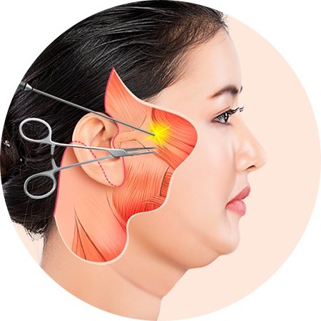 여성 얼굴 측면에 SMAS층 근육 구조와 절개 라인, 수술 기구를 통한 박리 과정을 나타낸 SMAS안면거상 수술 도해
