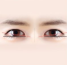 남자 눈성형 진단을 위해 양쪽 눈의 눈꼬리 각도와 수평 기준선을 붉은색 및 검은색 선으로 분석한 도해