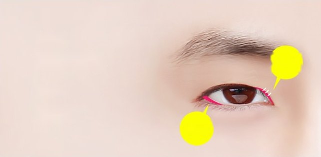 남성 눈성형 앞트임과 밑트임 수술 부위를 분홍색 선과 노란색 지시 기호로 표시한 눈 클로즈업 도해