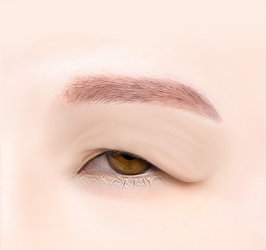 Hình ảnh đồ họa dáng mắt có da mí mắt bị chùng xuống che khuất đuôi mắt và tầm nhìn trước khi phẫu thuật nâng cung mày trên